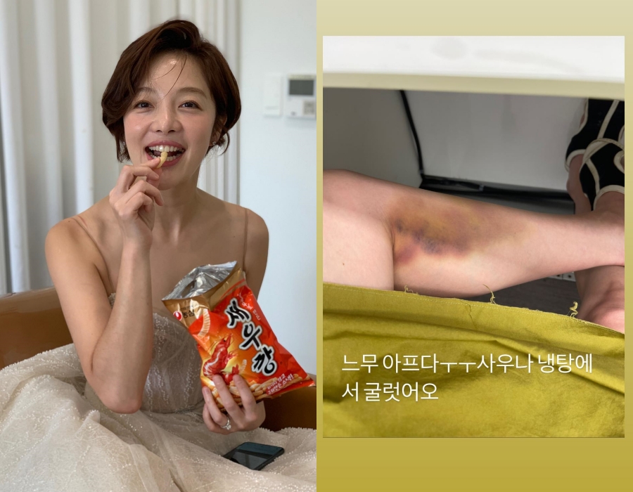 '김영훈♥' 황보라, 종아리에 피멍 가득 충격 사진 