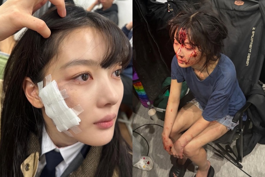 김유정, 얼굴에 피 칠갑하더니 커다란 멍까지…열연 모멘트에 
