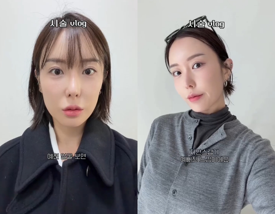 '애셋맘' 이소라, 성형수술 이어 중안부 시술까지 